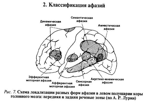 Афазия. 