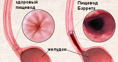Пищевод Барретта или метаплазия Барретта — серьезное осложнение рефлюксной болезни (ГЭРБ), заключающееся в патологическом изменении слизистой оболочки пищевода. 