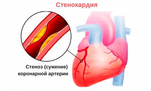 Канадская классификация стабильной стенокардии, 1976 г. 