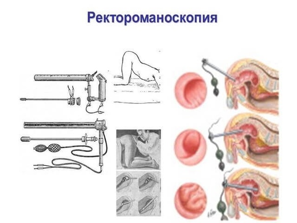 Ректороманоскопия — метод медицинской диагностики, при котором производится визуальный осмотр слизистой оболочки прямой кишки и в некоторых случаях дистальных отделов сигмовидной кишки. Исследование осуществляется с помощью специального прибора, ректороманоскопа. Он представляет собой трубку, которая содержит в себе осветительный прибор и устройство подачи воздуха. Воздухом раздувается полость прямой кишки, затем система подачи воздуха отсоединяется и устанавливается окуляр. 