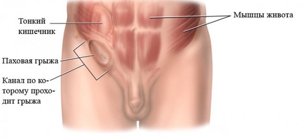 Лечите паховую грыжу своевременно 