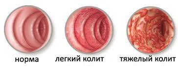 КОЛИТ