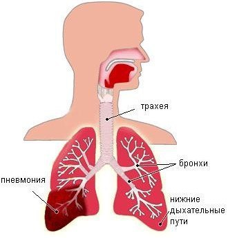 КРУПОЗНАЯ ПНЕВМОНИЯ. Клиника и диагностика.