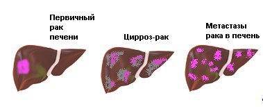 РАК ПЕЧЕНИ