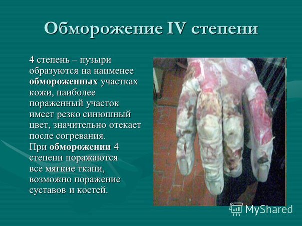 Что такое обморожение