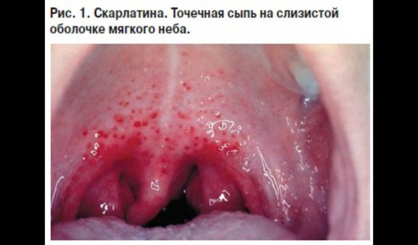 Скарлатина