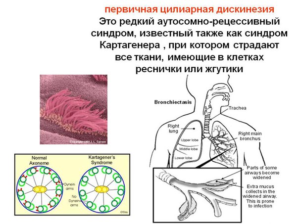Первичная цилиарная дискинезия 