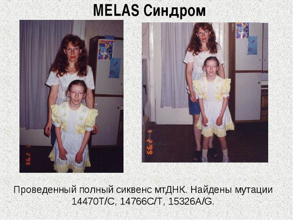 Синдром МELAS - заболевание, обусловленное точковыми мутациями в митохондриальной ДНК. Возраст начала заболевания широко варьирует от младенческого до взрослого, однако наиболее часто первые признаки обнаруживаются в возрасте от 5 до 15лет. В большинстве случаев болезнь дебютирует инсультоподобными эпизодами, злокачественными мигренями или задержкой психомоторного развития. Наиболее часто инсульты локализуются в височной, теменной или затылочной долях головного мозга, сопровождаются гемипарезом и гемианопсиеи и имеют тенденцию к быстрому восстановлению. 