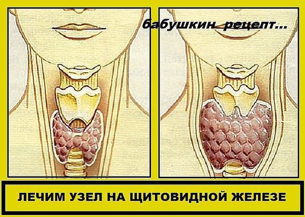 ЛЕЧИМ УЗЕЛ НА ЩИТОВИДНОЙ ЖЕЛЕЗЕ 