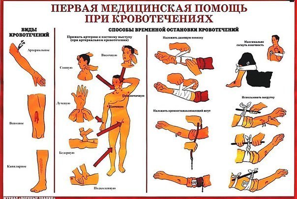 Методы временной остановки кровотечения