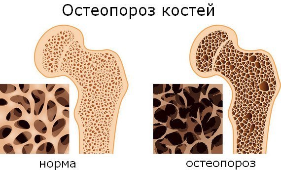 ОСОБЕННОСТИ ПИТАНИЯ ПРИ ОСТЕОПОРОЗЕ 