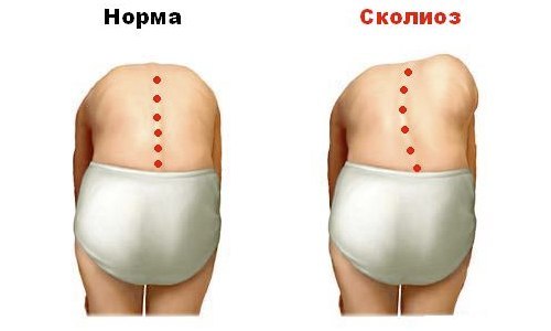 КОМПЛЕКС УПРАЖНЕНИЙ ПРИ СКОЛИОЗЕ