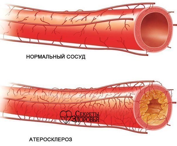 КАК УКРЕПИТЬ СОСУДЫ