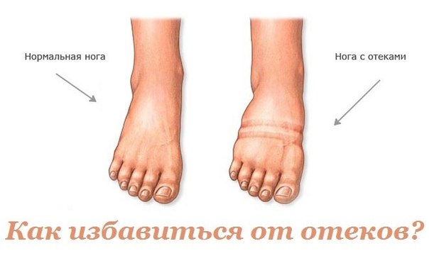 Как избавиться от отеков 