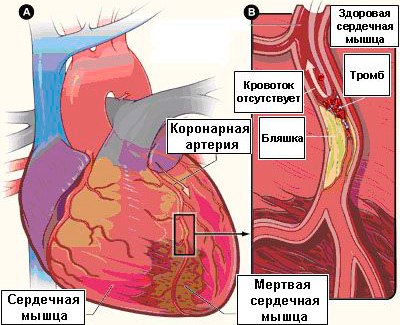 Новый метод поможет определить риск образования тромбов в сердце