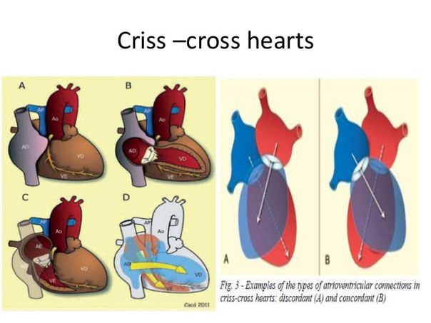CRISS-CROSS СЕРДЦА 