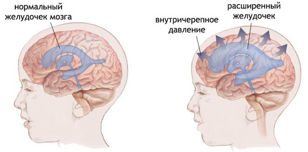Внутричерепное давление в норме