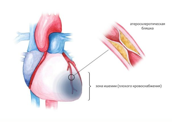 Причины болей в сердце при ИБС 