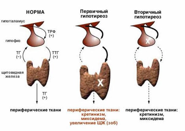 ГИПОТИРЕОЗ