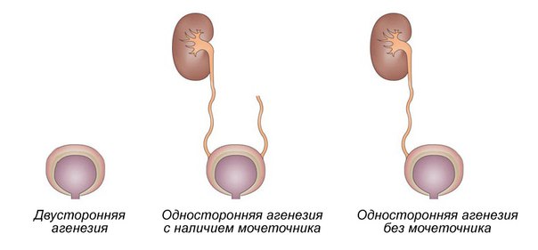 Агенезия почек