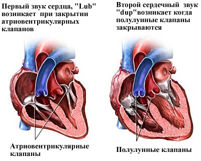 Аортальная недостаточность 