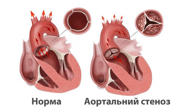 Аортальный стеноз 