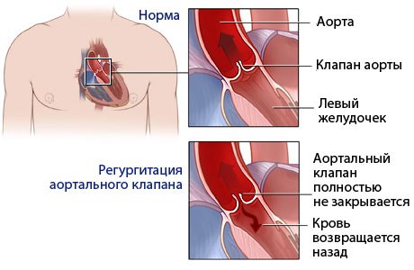 Недостаточность клапана аорты
