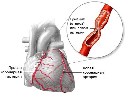 Стенокардия (Ст, одна из форм ИБС) - симптомокомплекс (клинический синдром), характеризующийся особой рецидивирующей приступообразной загрудинной (или в прилегающих областях) болью (либо ее эквивалентами) или дискомфортом (стеснением) в результате острой ишемии миокарда (без развития его некроза), вызванной нарушением равновесия между коронарным кровотоком и потребностями миокарда в кислороде (последние превышают доставку). Ст обычно возникает у больных с поражением, как минимум, одной крупной эпикардиальной артерии. 