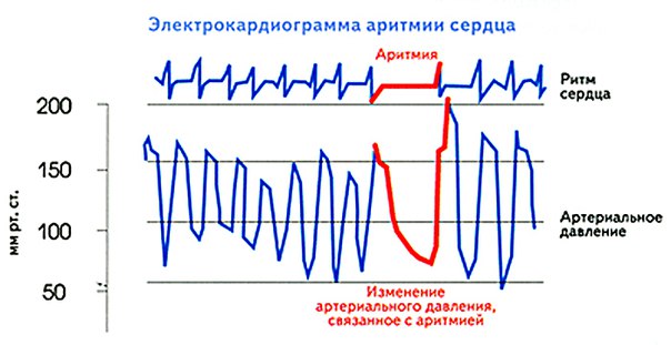 Нарушение сердечного ритма - это нарушение частоты, ритмичности и последовательности сокращений сердечной мышцы. 