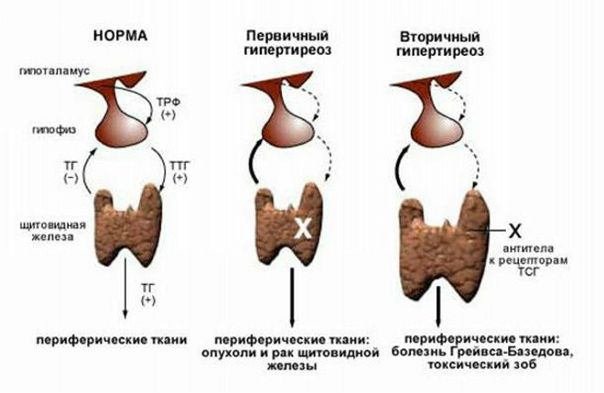 Тиреотоксические кризы