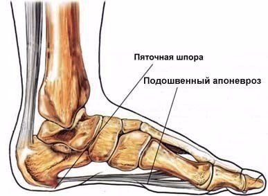 Лечение пяточной шпоры с помощью народных средств 