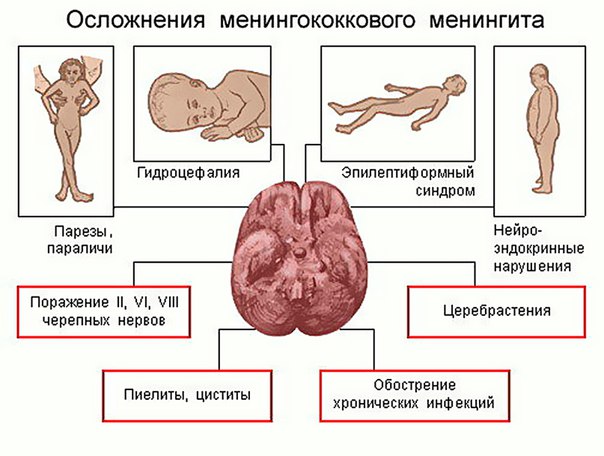 Менингококковая инфекция 