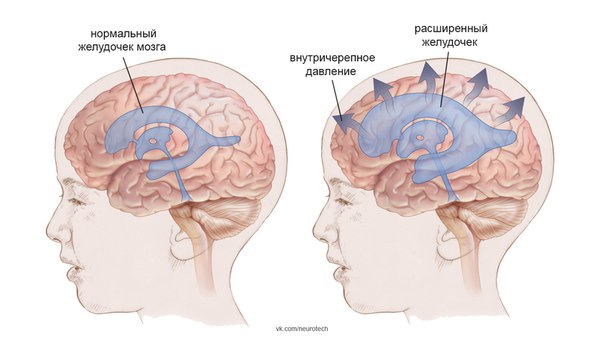 Доброкачественная, или идиопатическая, внутричерепная гипертензия (повышение внутричерепного давления до 20–30 мм рт. ст) встречается у пациентов любого возраста, но наиболее часто у людей 30–40 лет, причем у женщин – в 8 раз чаще. Ее возникновение ассоциируется с рядом патологических состояний – ожирением, беременностью, нарушением менструального цикла, эклампсией, эндокринными заболеваниями, отравлением тяжелыми металлами, приемом некоторых лекарственных средств, инфекционными и паразитарными болезнями, анемией и др. 
