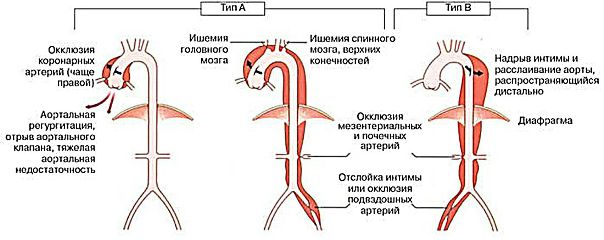 Расслоение аорты - разрыв интимы с последующим расслоением стенки на различном протяжении и кровотечением в срединный слой. 