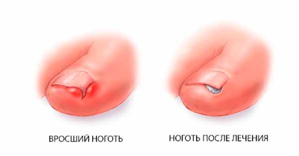 Вросший ноготь (онихокриптоз) — врастание ногтевой пластины в боковой край ногтевого валика (чаще всего на большом пальце ноги, чаще внешний край). Это весьма распространённое заболевание. При этом ногтевой валик становится красным и отёчным, начинается воспаление, вызывающее сильную боль. В дальнейшем возможно развитие хронического воспалительного процесса.
