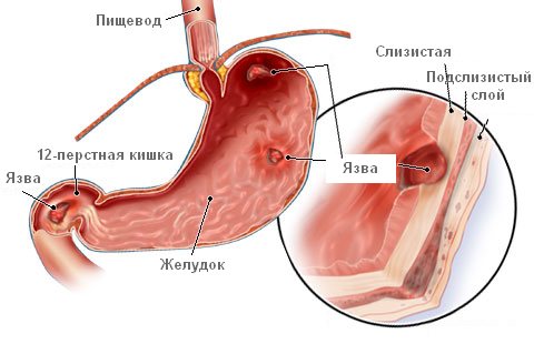 Синдромы в гастроэнтерологии