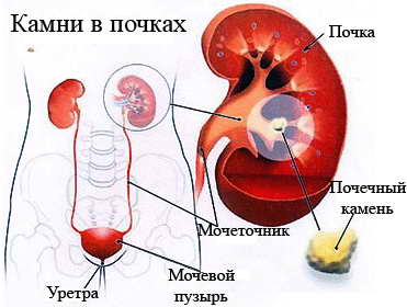 Камни в почках: народное лечение 