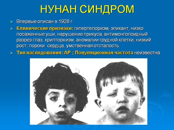 Синдром Noonan плейотропный синдром встречается довольно часто (1 случай на 1000-2500 детей, рожденных живыми) и в основном поражает сердечно-сосудистую систему. Для больных синдромом Noonan, наследуемым по аутосомно-доминантному типу, характерны низкий рост, иногда С необычной деформацией грудины, вальгусная деформация локтевого сустава, складки на шее, врожденная лимфедема и ВПС. 