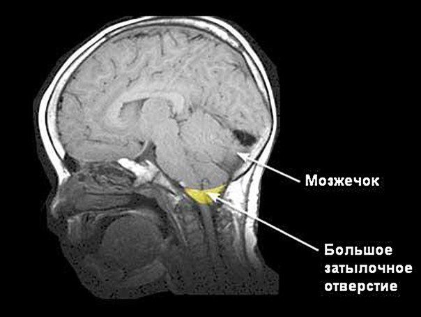 Синдром Арнольда-Киари 