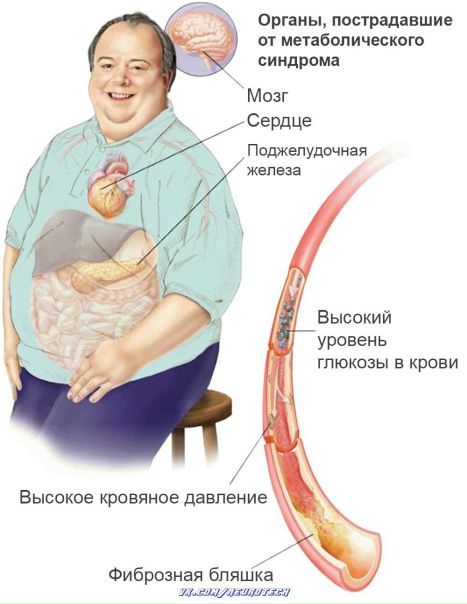 Метаболический синдром как причина атеросклероза 