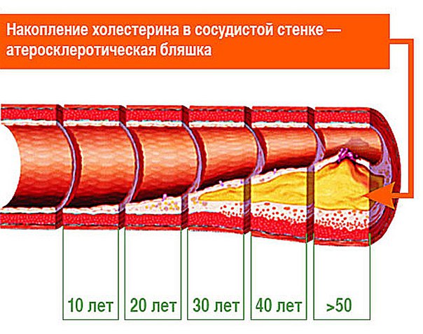 Стадии атеросклероза: