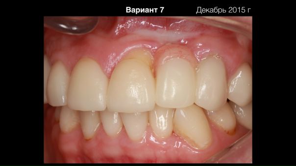 Один из вариантов коррекции десны (устранении рецессии десны)!