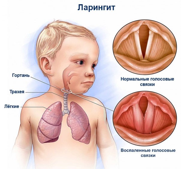 ОСТРЫЙ ЛАРИНГИТ 