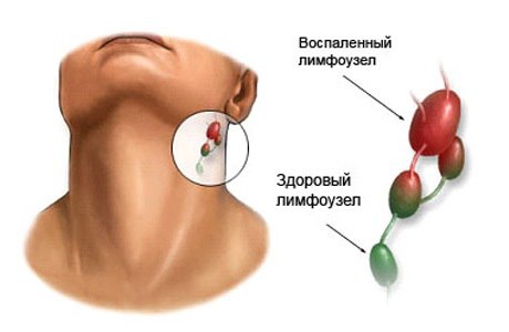 Лимфаденит 