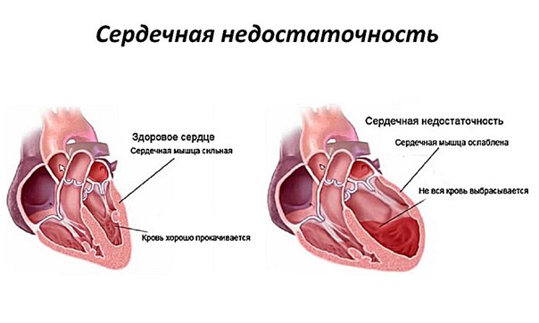 СЕРДЕЧНАЯ НЕДОСТАТОЧНОСТЬ 