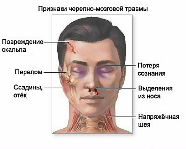 Повреждения нервов и мозговых центров при травме головы 