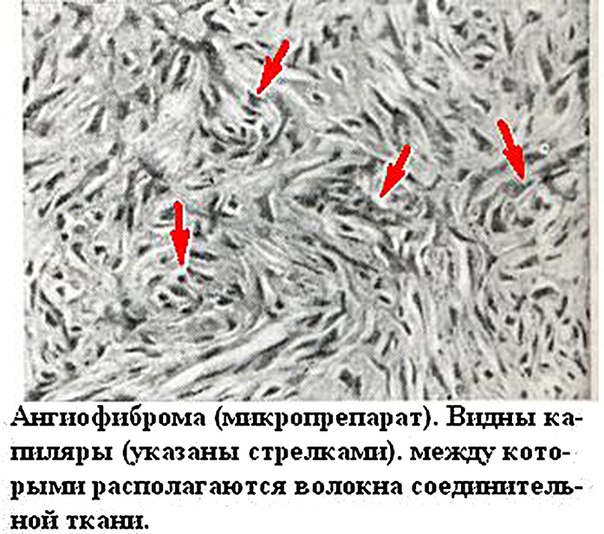 Ангиофиброма (angiofibroma; синоним: фиброангиома, склерозирующая ангиома)— опухоль типа ангиомы, в которой много волокнистой соединительной ткани, либо фибромы с большим количеством сосудов. 