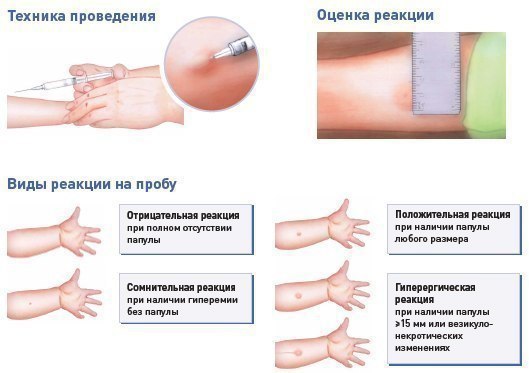 Реакция Манту: норма или пора к фтизиатру 