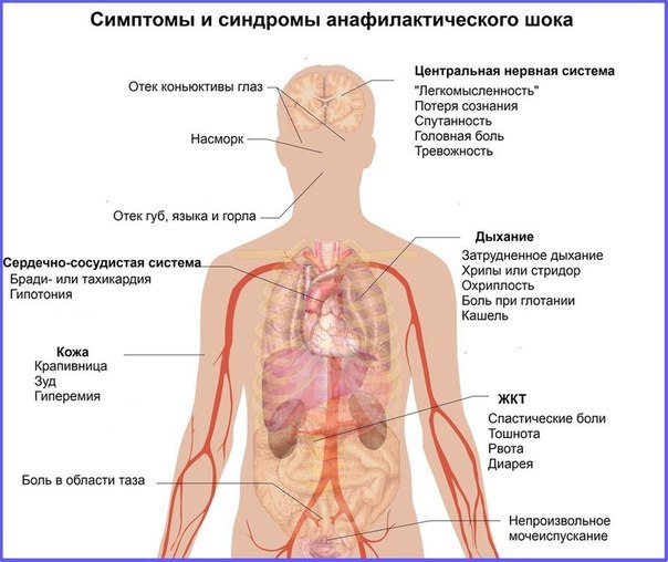 Анафилаксия — аллергическая реакция немедленного типа, состояние резко повышенной чувствительности организма, развивающееся при повторном введении аллергена.