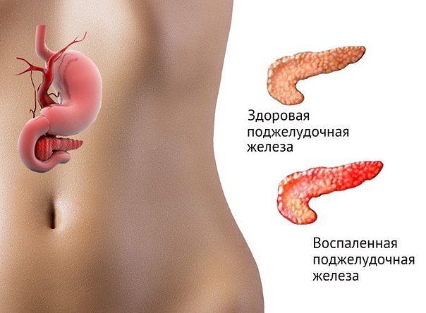 Если беспокоит поджелудочная железа.